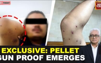 Exclusive: Safdarjung Hospital report confirms pellet gun injuries at NEET protest