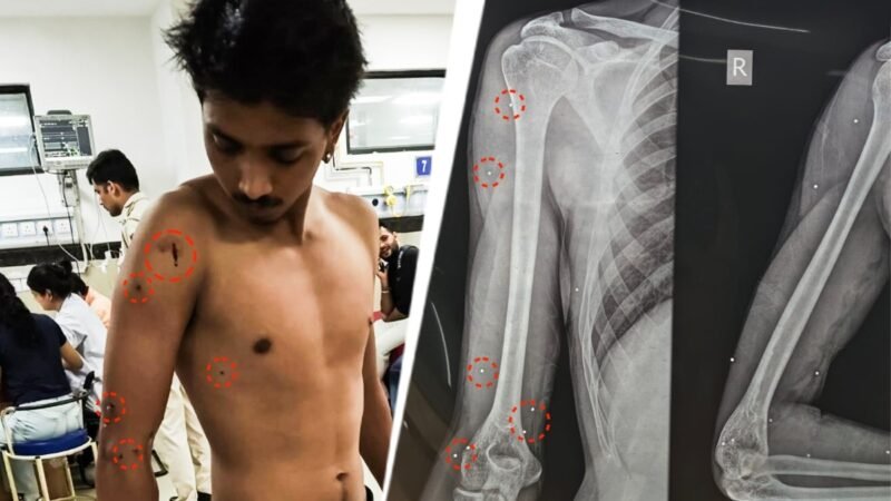 Fifth pellet gun victim says he knows of a sixth protester who was shot in Delhi